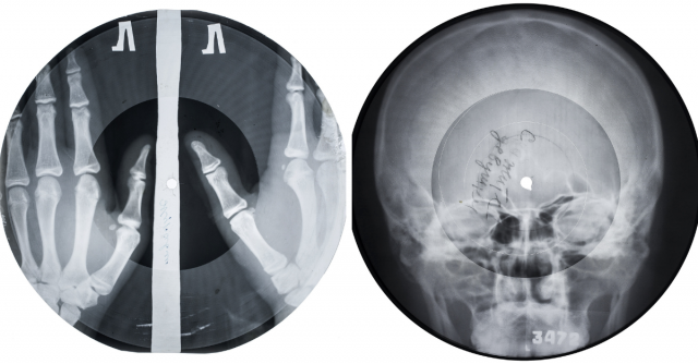Fottere l’autorità per amore della musica: “X ray audio”, stampe pirata su radiografie scartate ("bone music, la musica delle ossa").