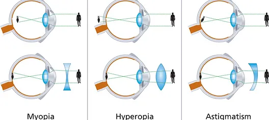 Refractive Errors