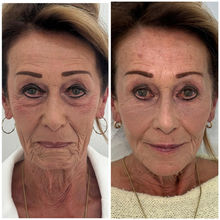 liquid skin lift before and after