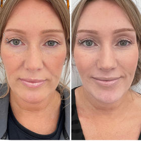 Before and after some aesthetic treatments