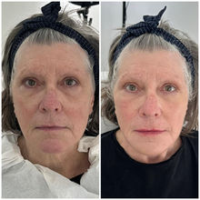 liquid skin lift before and after