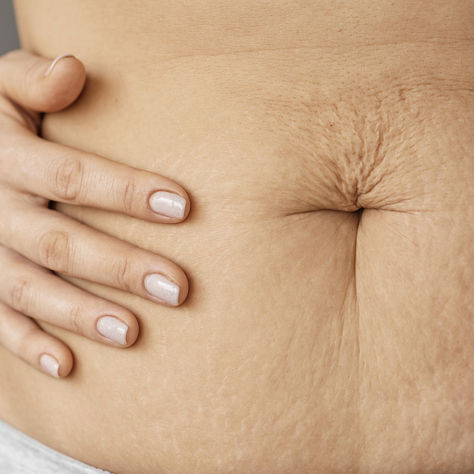 Diástase abdominal - dúvidas frequentes respondidas
