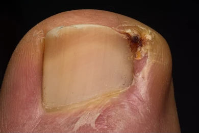 Ingrown toe nail operation - Gold Coast