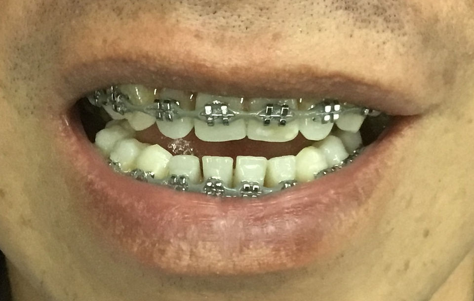 Colocación de brackets en el paciente Ivan Sanchez) Dental Unlimited