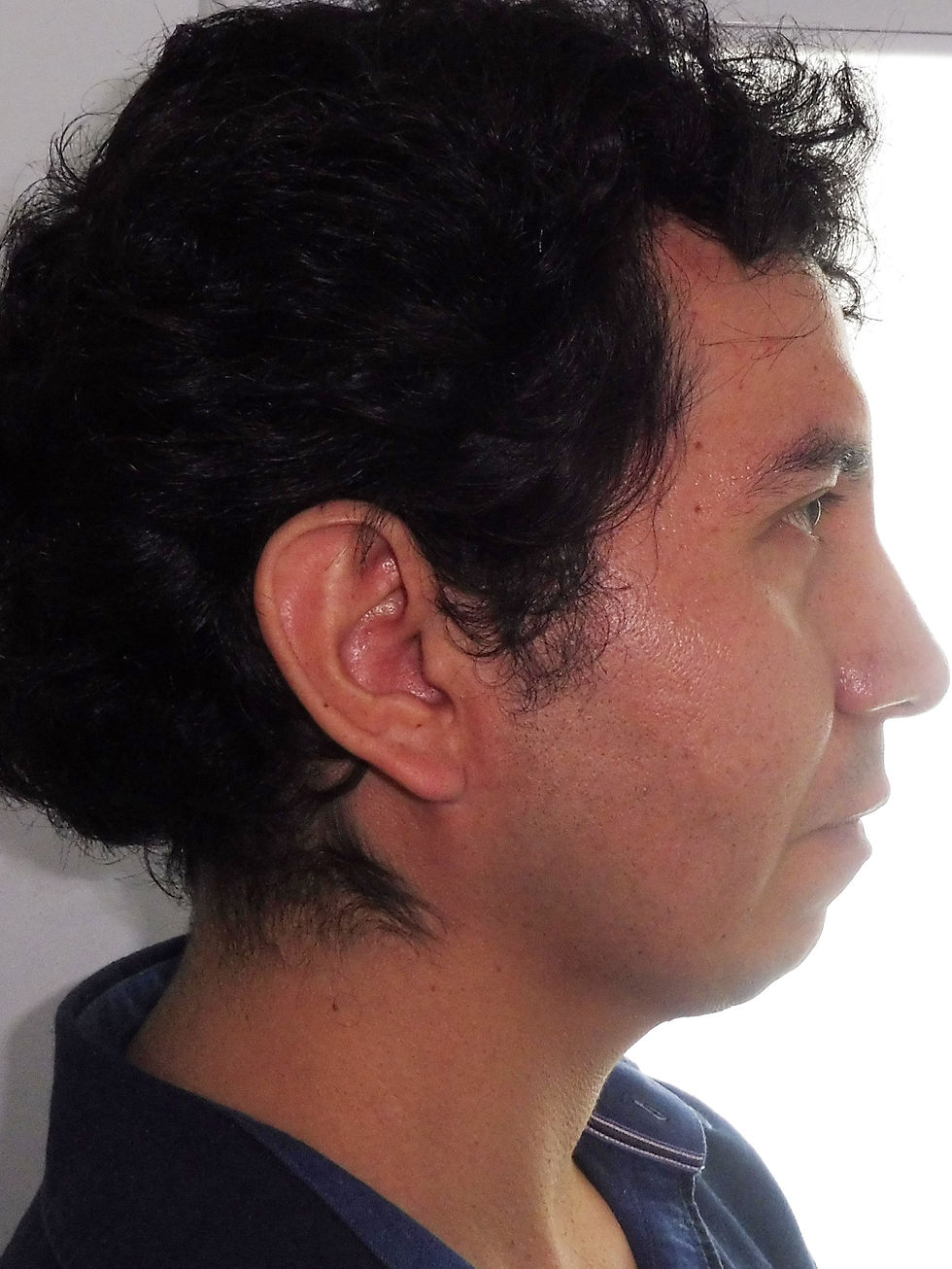 Extraoral Perfil