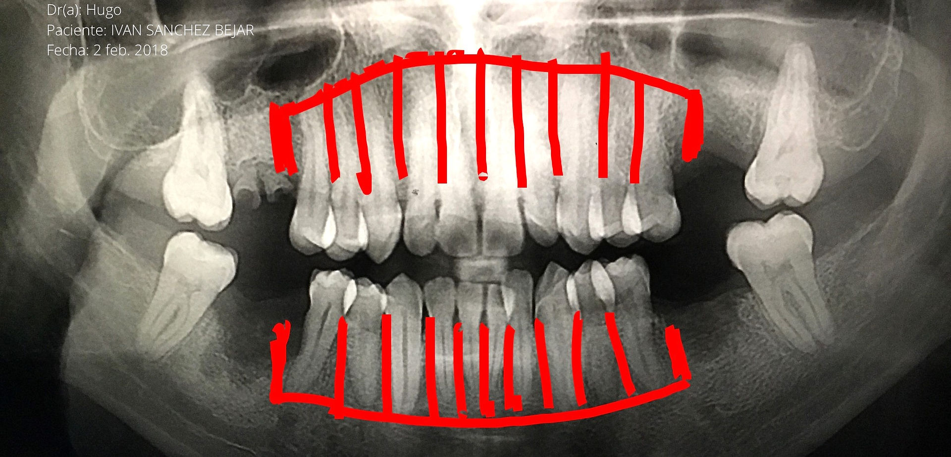 Marcación donde se realizará la cirugía osteogénica por protrusión maxilar y mandibular (Dental Unlimited)