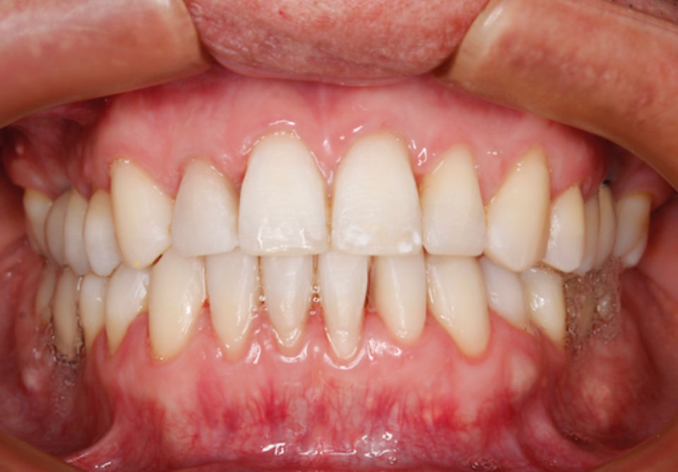Fotografía intraoral anterior después de tratamioento de Protrusión maxilar y mandibular con Ortodoncia osteogénica en 8 meses (Dental Unlimited)