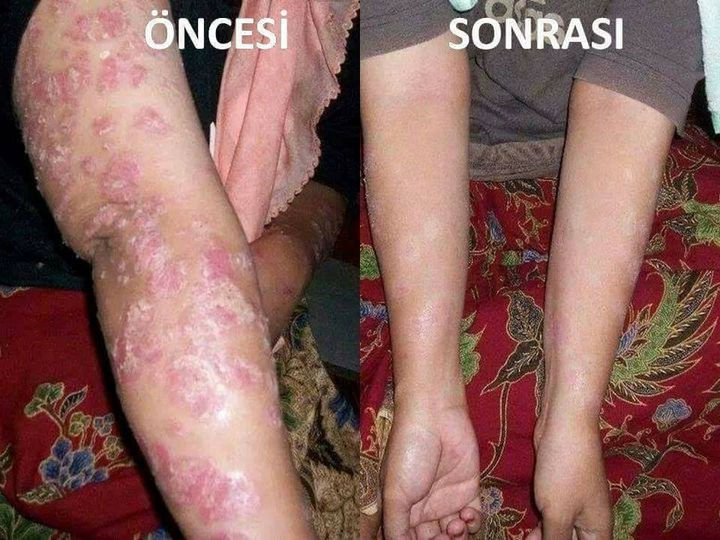 SEDEF HASTALIĞINDA KIRMIZI REİSHİ MANTARI