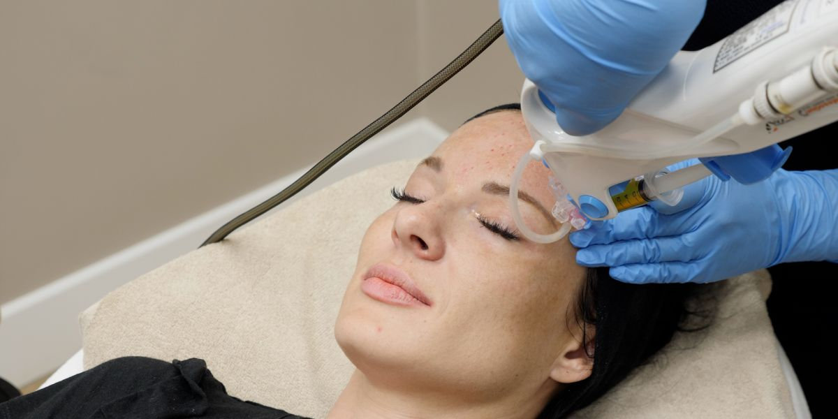 PRP Vampire Facial Hair Growth Dr Chris Giezing