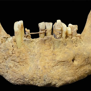 La dentisterie restauratrice existait en Écosse médiévale