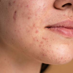 Brossage de dents et acné ; lien de causalité ?