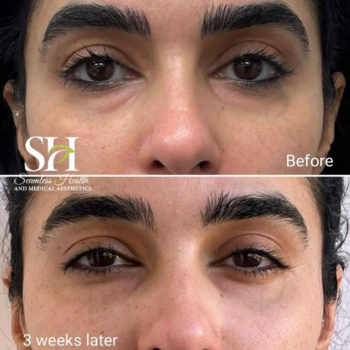 PRP Naturagel Training Toronto EZGEL PRF