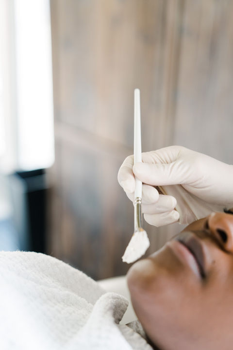 Clear skin after chemical peel treatment