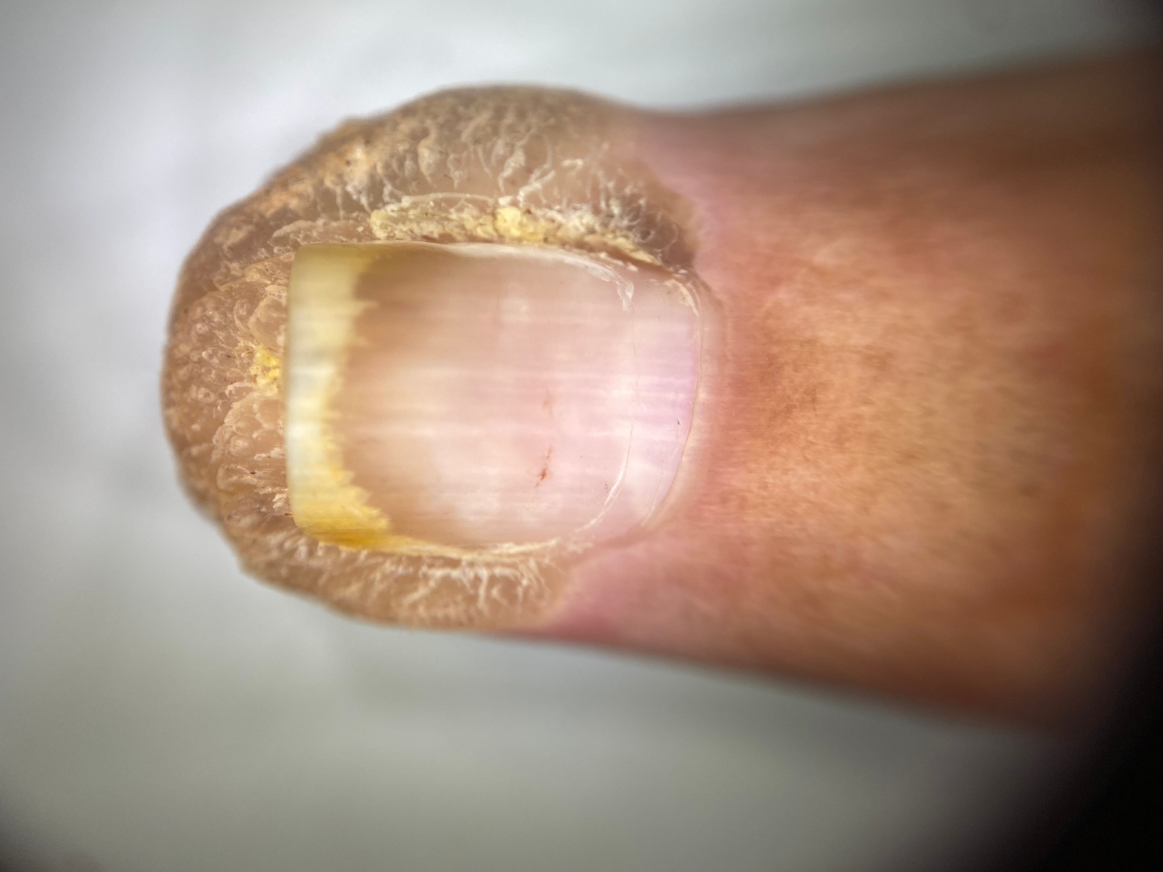 Cirurgia de verruga | Dr. Miguel Ceccarelli, image size:4032x3024