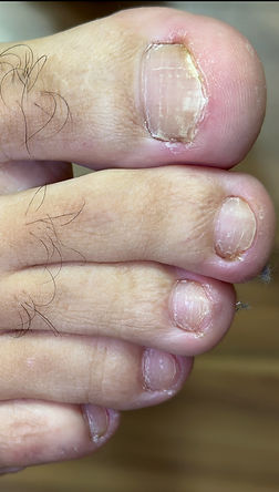 antes e depois de micose de unhas