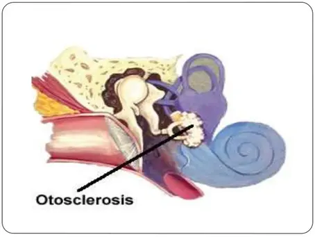 Audiological Findings in Otosclerosis