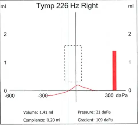 Tympanogram showing As type tympanograph. Tymp 226 Hz Right with a graph. Red line peaks at 300 daPa. Text includes Volume: 1.41 ml, Pressure: 21 daPa.