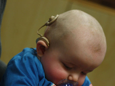 Sleeping baby with a cochlear implant, head bowed in a blue shirt against a blurred warm background.