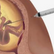 arte de uma agulha furando uma barriga de uma gestante até atingir o feto
