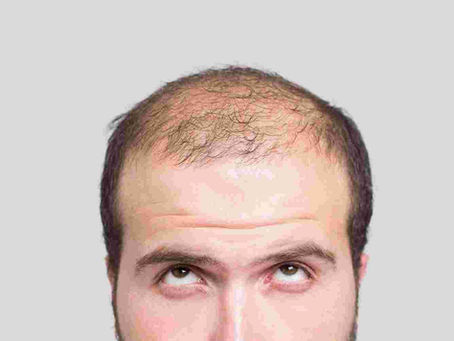 Hair fall problems in Astrology