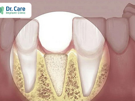 Cách chữa tiêu xương răng hiệu quả nhất hiện nay - Chi phí điều trị giá bao nhiêu?