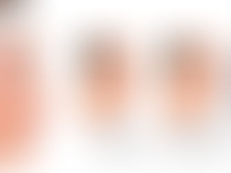 Bị tiêu xương có trồng răng giả nguyên hàm được không?