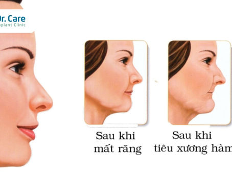 Bị tiêu xương có trồng răng giả nguyên hàm được không?