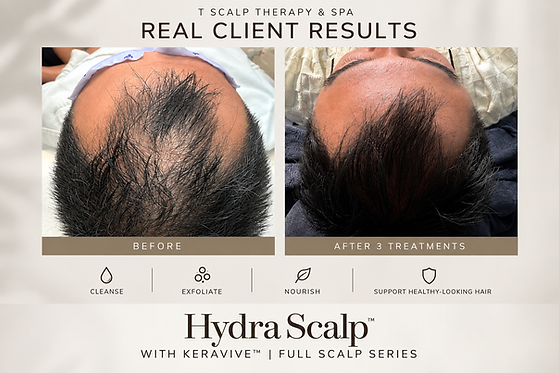 HydraScalp Keravive Scalp Therapy Full Scalp T Scalp Therapy & Spa Fountain Valley.png
