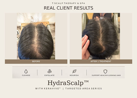 Keravive Hydrscalp Targeted Crown Frontal Area T Scalp Therapy & Spa Fountain Valley.jpg