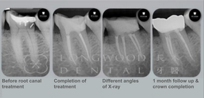 How many visits are required for root canal treatments?