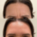 Before and oafter of botox injections