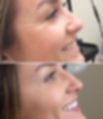 Before and oafter of botox injections