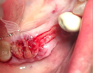 Dr. Alka Adyalkar, Dental Implant Treatment