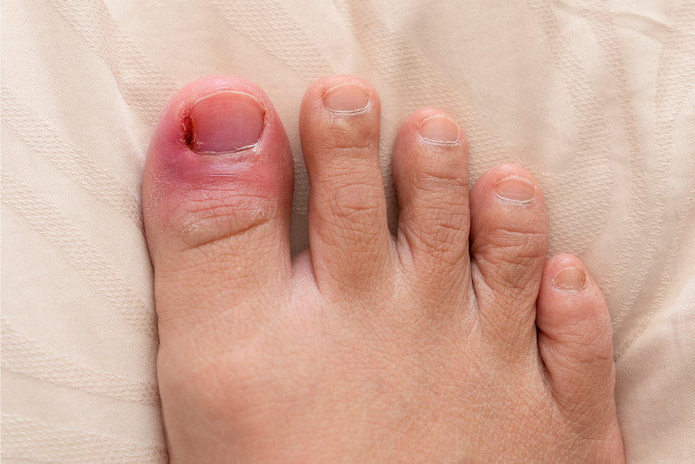 Ingrown Toenails and Nail Surgery