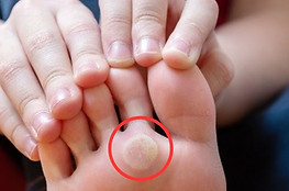 Foot-Corn_edited.jpg