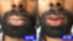 leucoderma treatment in hindi