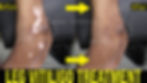 leg vitiligo treatment 1