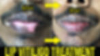 lip leucoderma tretment