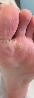 Verrue plantaire sous le pied avec épaississement cutané et points noirs, infection virale fréquente traitée en podologie.