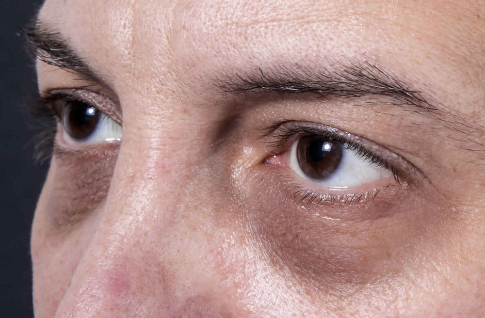 Apa Beza Eyebag Dan Dark Circle lingkaran Gelap Bawah Mata 