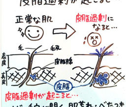 【②皮脂分泌】ニキビが出来る５段階メカニズム！ニキビを改善する５段階メカニズム！