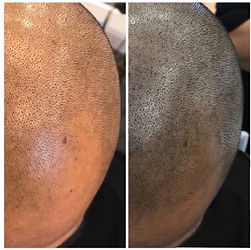 scalp micropigmentation