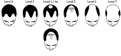 Refresh MD Spa - Stages of Hair Loss