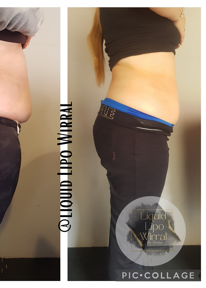 Before and after image with Liquid Lipo Wirral
