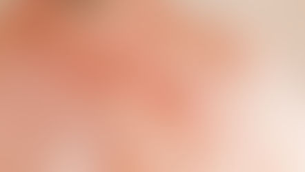 Nursing Care After a Pacemaker Insertion