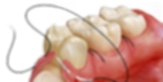 o que é um dente do siso?