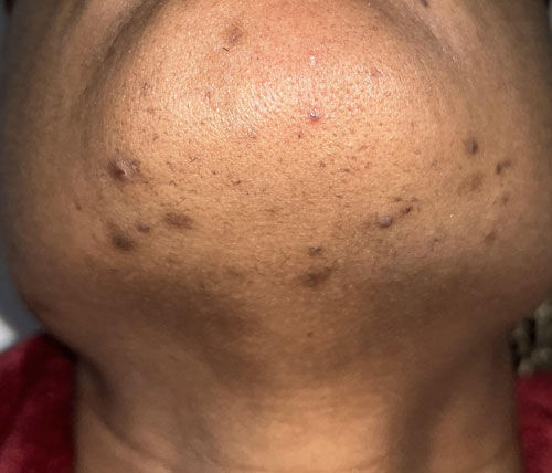 Pelos encravados e manchas: por que acontecem e como clarear a pele