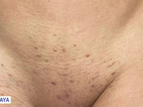 Foliculite na virilha: causas, sintomas e como tratar com segurança