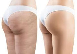 TRATAMIENTO ANTICELULITICO PIEL DE NARANJA Y FLACIDEZ.jpg