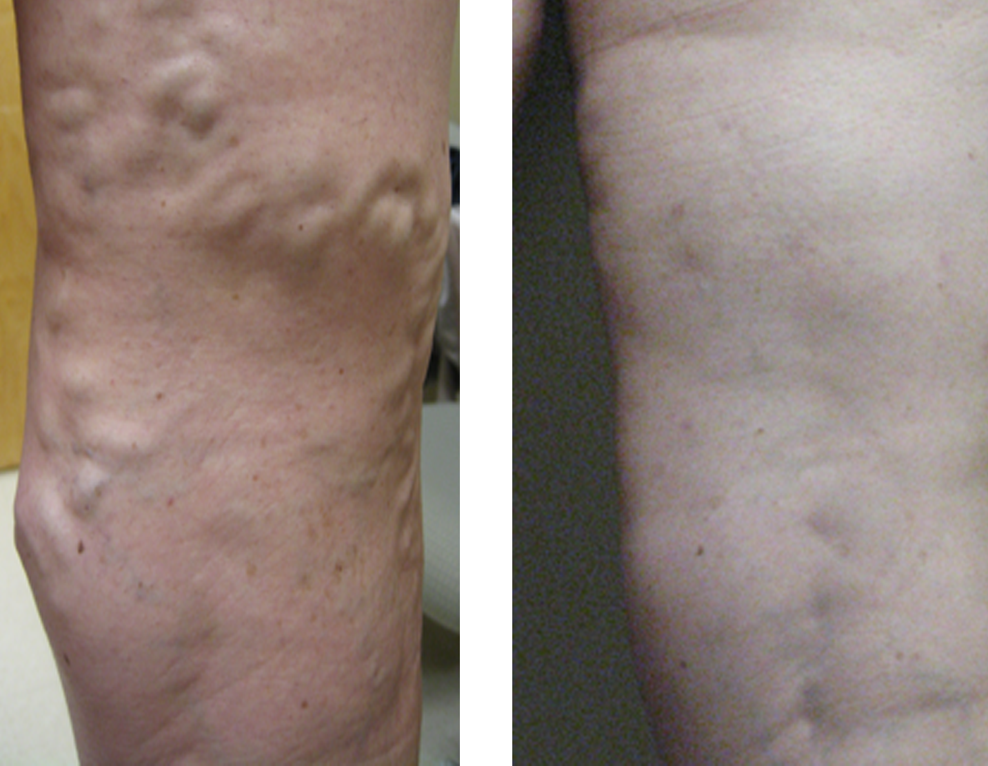 Vein Disease & Varicose Vein Treatment | Evansville, IN Owensboro, KY